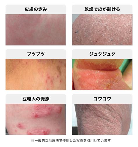 皮膚病|「皮膚」に関わる病気リスト